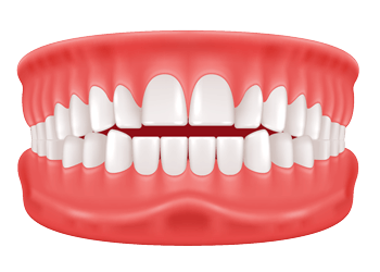 open bite
