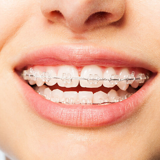 Ceramic Braces in Dubai - Transparent Dental Braces in Dubai