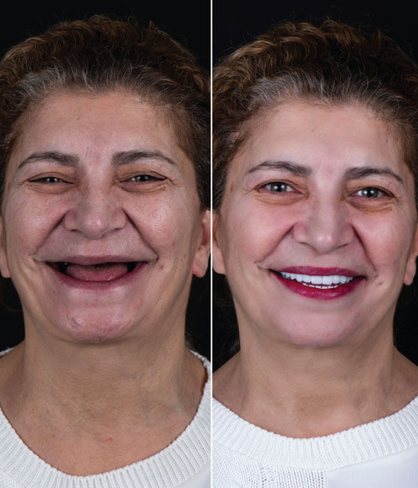Full Mouth Rehabilitation